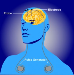 Basic DBS device