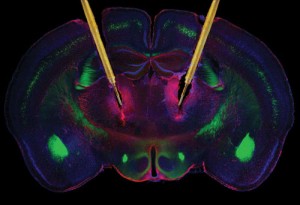 DBS electrodes in the brain